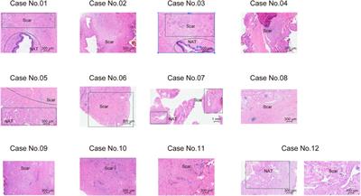 Comprehensive proteomic characterization of urethral stricture disease in the Chinese population